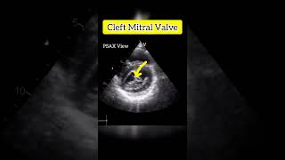 Cleft Mitral Valve Echocardiogram echocardiography mitral heart [upl. by Payton]