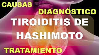 Tiroiditis de Hashimoto Fisiopatología Diagnóstico y Tratamiento [upl. by Yorgos]