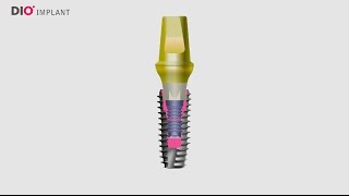 Indexing Dental Implant Abutments Correctly [upl. by Cosette]