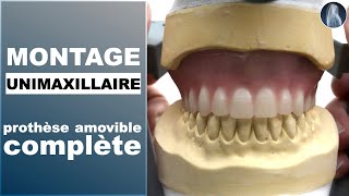 Unimaxillaire  Montage des dents  Prothèse amovible complète  Prothèse dentaire  © [upl. by Imailiv]