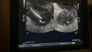 A case of didelphys uterus one containing IUCD amp agenesis of right kidney uterusultrasound [upl. by Elenahc]