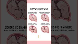 4 Types of twins medically Twin pregnancies pregnant youtubeshorts twins September 4 2024 [upl. by Egin943]