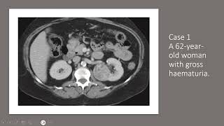 genitourinary cases part 1 [upl. by Ahsieit]