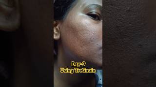 Day9 Using Tretinoin 0025 Cream viralvideo tretinoin shorts youtubeshorts skincare [upl. by Thecla]