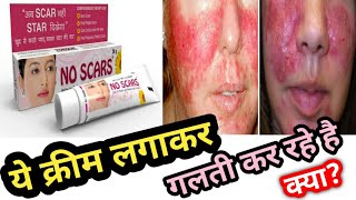 No Scar Cream Honest Review 2021 In Hindi Side Effects Uses  Price  My opinion  पूरी सच्चाई [upl. by Crowe]