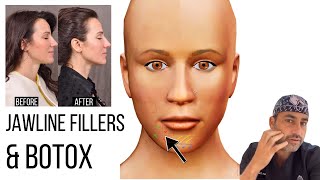 Jawline Fillers amp Botox Tips  What to Know  Beverly Hills Facial Plastic Surgeon Dr Ben Talei [upl. by Liryc370]