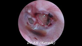 Double Traumatic Tympanic Membrane  Eardrum  Perforation [upl. by Lexis]