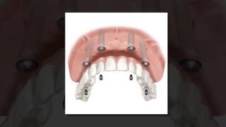 Implant Supported Dentures  Calgary Implant Dentures [upl. by Alikat]