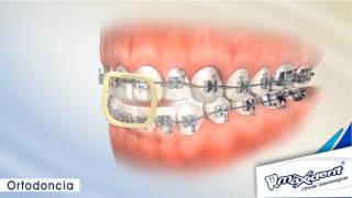 Corrección de mordida y espacios dentales quotOrtodonciaquot [upl. by Ainad]