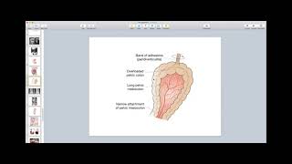 Intestinal Obstruction Part 2  General Surgery Course 4th  6th Stages [upl. by Niwri131]