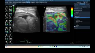 IQ 290 TFAST LUNG MASS ULTRASOUND ICP CPP ECHOPAC ANALYSIS ELASTOGRAPHY 3 [upl. by Steddman697]