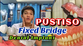 PUSTISO  Fixed  removable and Implant Pamalit sa nabunot na ngipin [upl. by Ahsenar184]