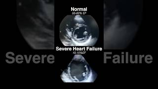 Echocardiogram NORMAL vs SEVERE HEART FAILURE radiology cardiology [upl. by Aniraz]