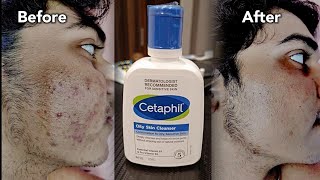 Cetaphil Oily Skin Cleanser Review cetaphilcleanser cetaphil [upl. by Wilkey]