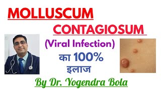 Molluscum Contagiosum ka 100 Treatment [upl. by Ecyar357]