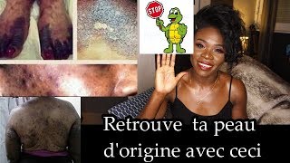 COMMENT RETROUVER RAPIDEMENT UNE BELLE PEAU APRES LA DEPIGMENTATION [upl. by Benni568]