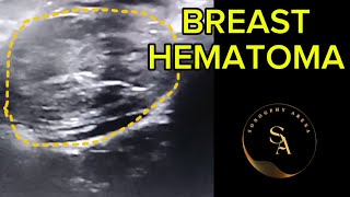 BREAST HEMATOMA Ultrasound case [upl. by Melac]