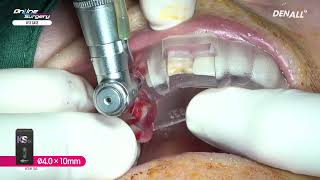 Online Surgery 13 immediate implant placement KSⅢ with dual zone graft [upl. by Narra]