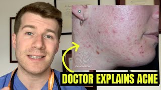 Doctor explains ACNE symptoms selfcare treatment options and complications [upl. by Artema609]