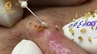 Treatment of blackheads and whiteheads 394  Loan Nguyen [upl. by Addam764]