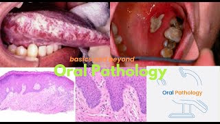 Squamous Odontogenic Tumor 2024 [upl. by Dorahs361]