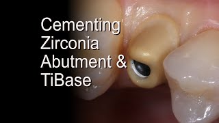 Dental Zirconia Implant Abutments [upl. by Aicenad508]