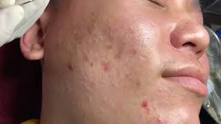 Acne Treatment Huong Da Nang membership 017 [upl. by Drehcir]