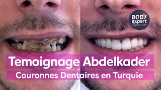 Témoignage Couronnes Dentaires Turquie Abdelkader [upl. by Rosenberger]