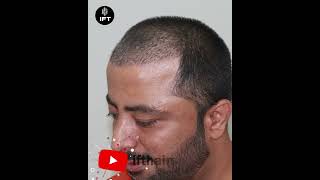 Best Hair Transplant in Jodhpur jodhpurhairtransplant hairtransplantinjodhpur iftclinic [upl. by Dobb410]