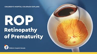 Retinopathy of Prematurity Diagnosis and Treatment [upl. by Clellan]