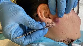 Drainage of an infected cyst in front of the ear [upl. by Anerhs621]