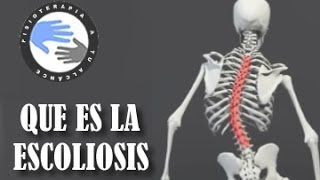 Que es la escoliosis de columna [upl. by Hsot]