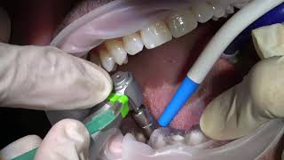 immidiate implant placement and loading [upl. by Ahsimin]