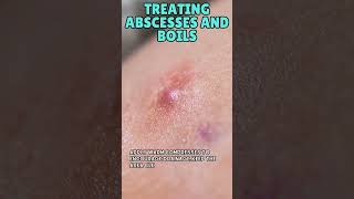 Treating Abscesses and Boils  Your Essential Guide to Skin Infections in the Wild [upl. by Aned]