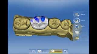 Unveiling the Power of Sirona CEREC SW 40 Complete Demonstration [upl. by Bilski]