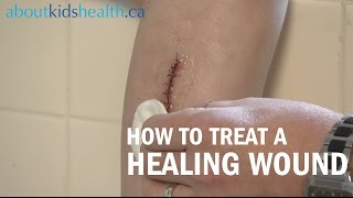 How to care for a healing wound  AboutKidsHealth at The Hospital for Sick Children [upl. by Initirb631]