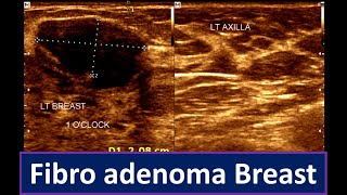 Fibroadenoma Breast Breast Lump  Brest ultrasonogram [upl. by Hareehat518]