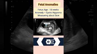 Fetal Anomaly ultrasound cyctic Hygromapregnancyultrasound medical baby [upl. by Spooner]