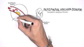 Cardiovascular Disease Overview [upl. by Mallis]