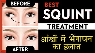 Best Squint treatment  Causes Symptoms amp Treatment of Squint  strabismus  भेंगापन का सरल इलाज [upl. by Ahcirt]