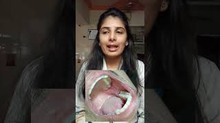 OperculectomyPericoronectomy ✅🦷✨ shortsviral dentistdoctor ytshorts shortvideo youtubeshorts [upl. by Sparke]