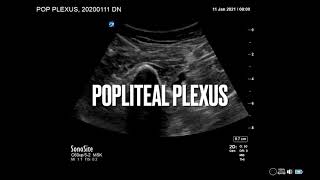 Popliteal plexus  Motorsparing block for TKA  alternative to IPACK Ultrasound regional anesthesia [upl. by Hannej]