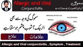 Smog Effect On Eyes  Allergic and Viral Conjunctivitis  Symptom Treatment Nafamine DrAHMandal [upl. by Amaryl]