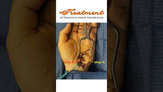 Treatment of Guyon’s canal syndrome Ulnar tunnel syndrome shorts [upl. by Nicolella]