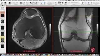 Systematic Interpretation of Knee MRI How I do it [upl. by Esojnauj766]