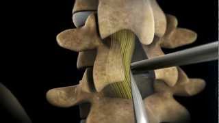 TLIF Transforaminial Lumbar Interbody Fusion  Larry Parker MD [upl. by Frendel]