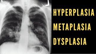 Hyperplasia Metaplasia amp Dysplasia Explained Cancer Biology [upl. by Bj]