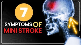 7 Symptoms of Mini Stroke  Transient Ischemic Attack  TIA  Signs [upl. by Anivlem889]