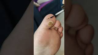 Removing Ingrown Toenail☺1 [upl. by Whitelaw]