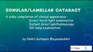 ZonularLamellar Cataract [upl. by Philender]